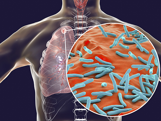 Mycobacterium tuberculosis, l'agente eziologico della tubercolosi.